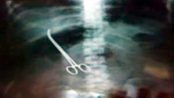 ভারতে রোগীর পেটে কাঁচি রেখেই অপারেশন শেষ করলেন ডাক্তার